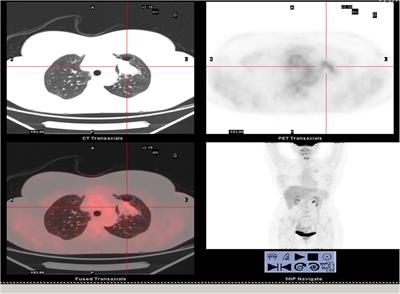Cancer Stem-Like Cells in a Case of an Inflammatory Myofibroblastic Tumor of the Lung
